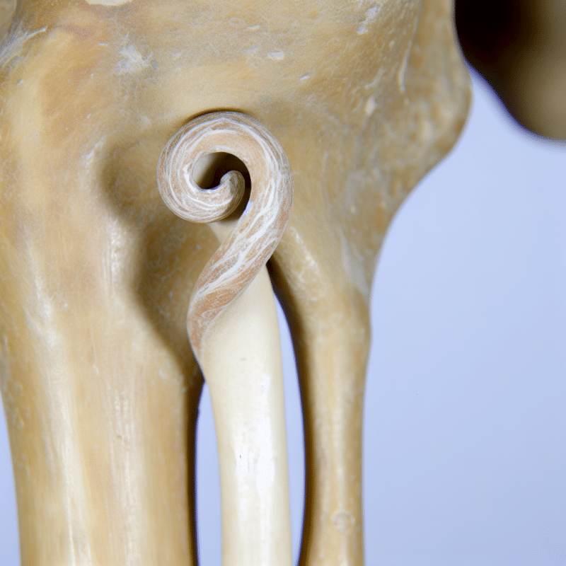 złamanie przezkrętarzowe kości udowej